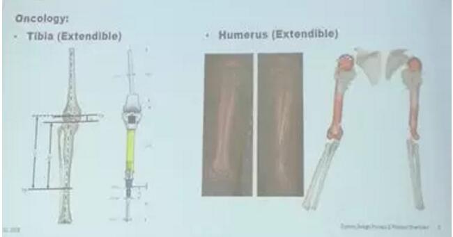 史賽克首席工程師解讀個性化骨科植入物注冊