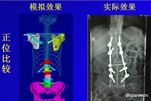 漢邦科技金屬3D打印骨科手術(shù)導(dǎo)板、接骨板及金屬牙冠應(yīng)用案例